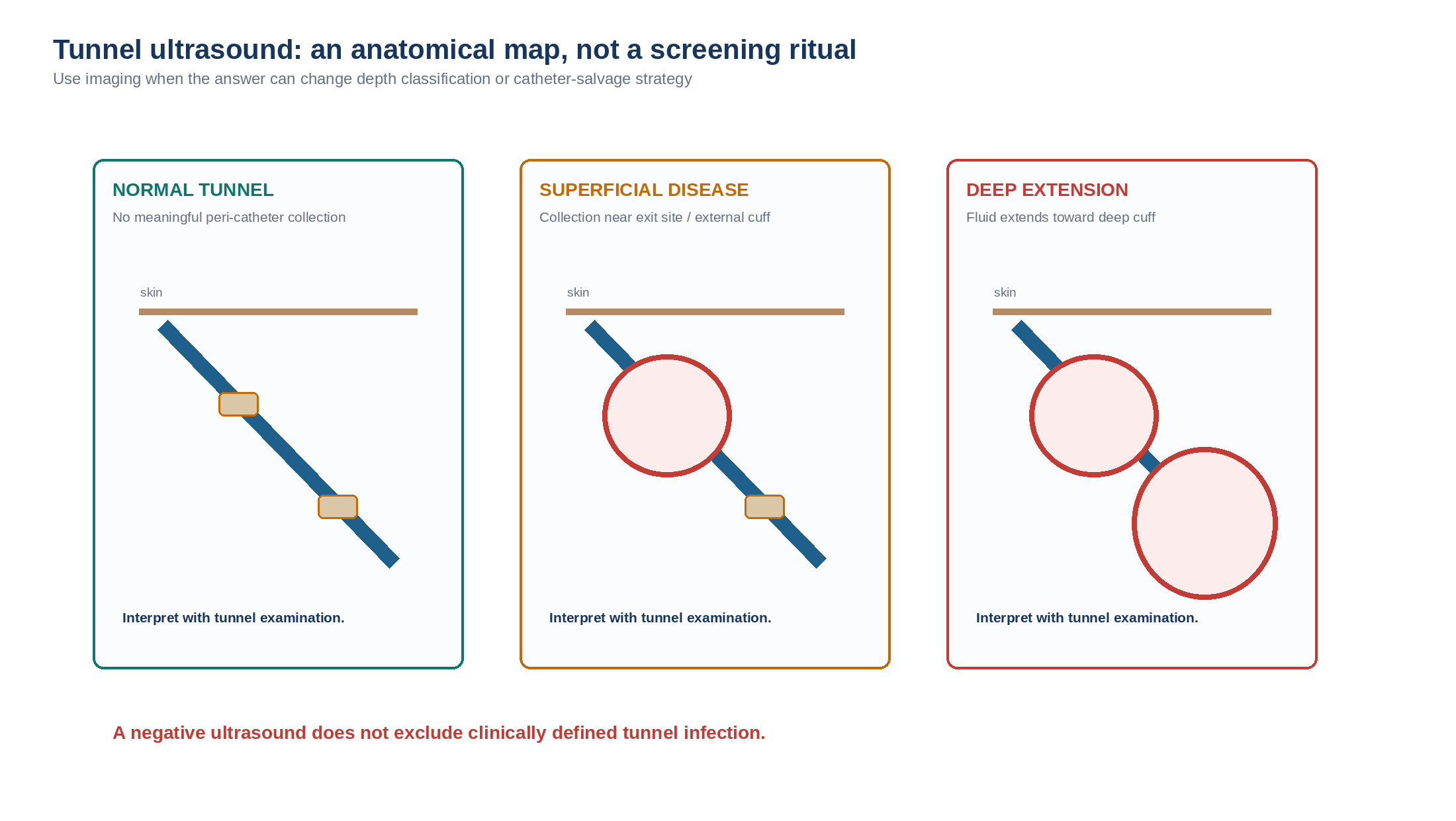 Figure 11.2 — Tunnel ultrasound can map superficial versus deeper peri-catheter involvement and help determine whether a catheter is anatomically salvageable.