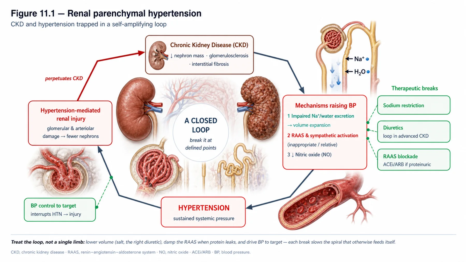 Figure 11.1 - Renal parenchymal hypertension