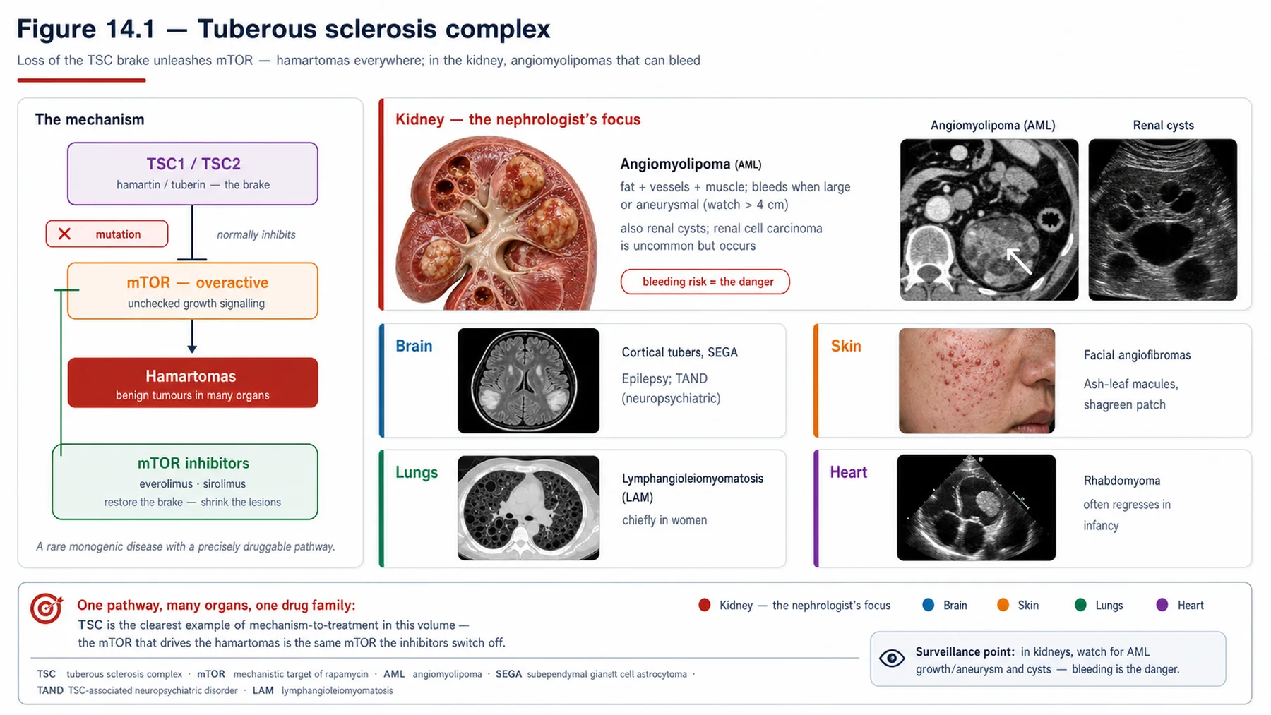 Figure 14.1 - Tuberous sclerosis complex